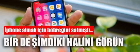 İphone almak için böbreğini satmıştı! Şimdiki halini gören inanamıyor
