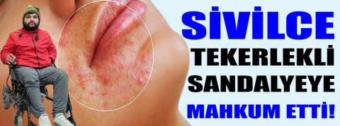 Sivilce tekerlekli sandalyeye mahkum etti