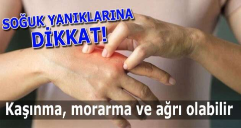 Soğuk yanıklarına dikkat; Kaşınma, morarma ve ağrı olabilir